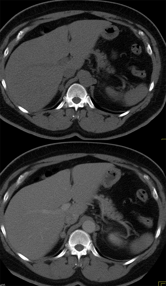 CT of the Adrenal Mass