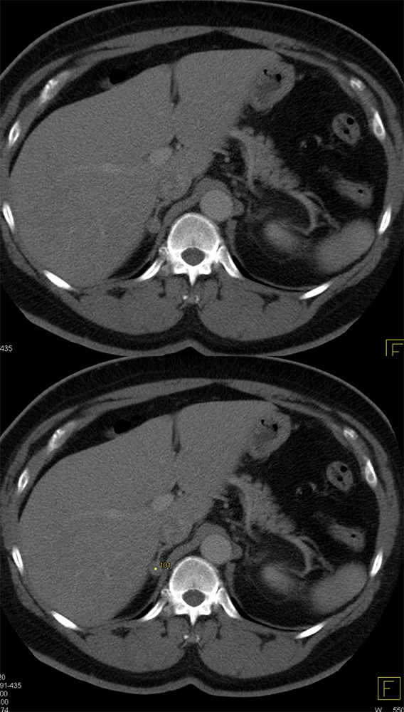 CT of the Adrenal Mass