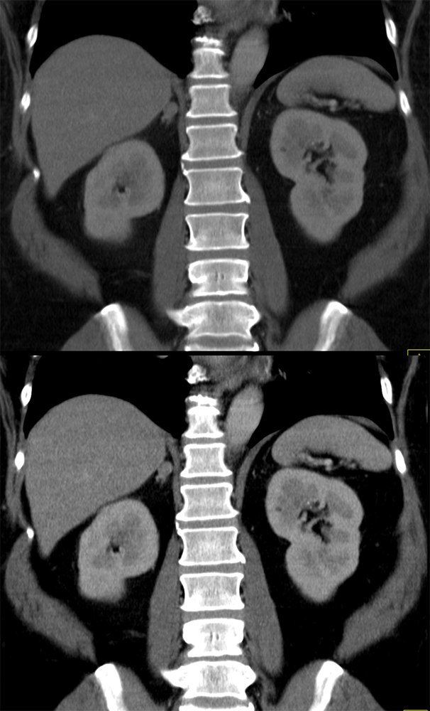 CT of the Adrenal Mass