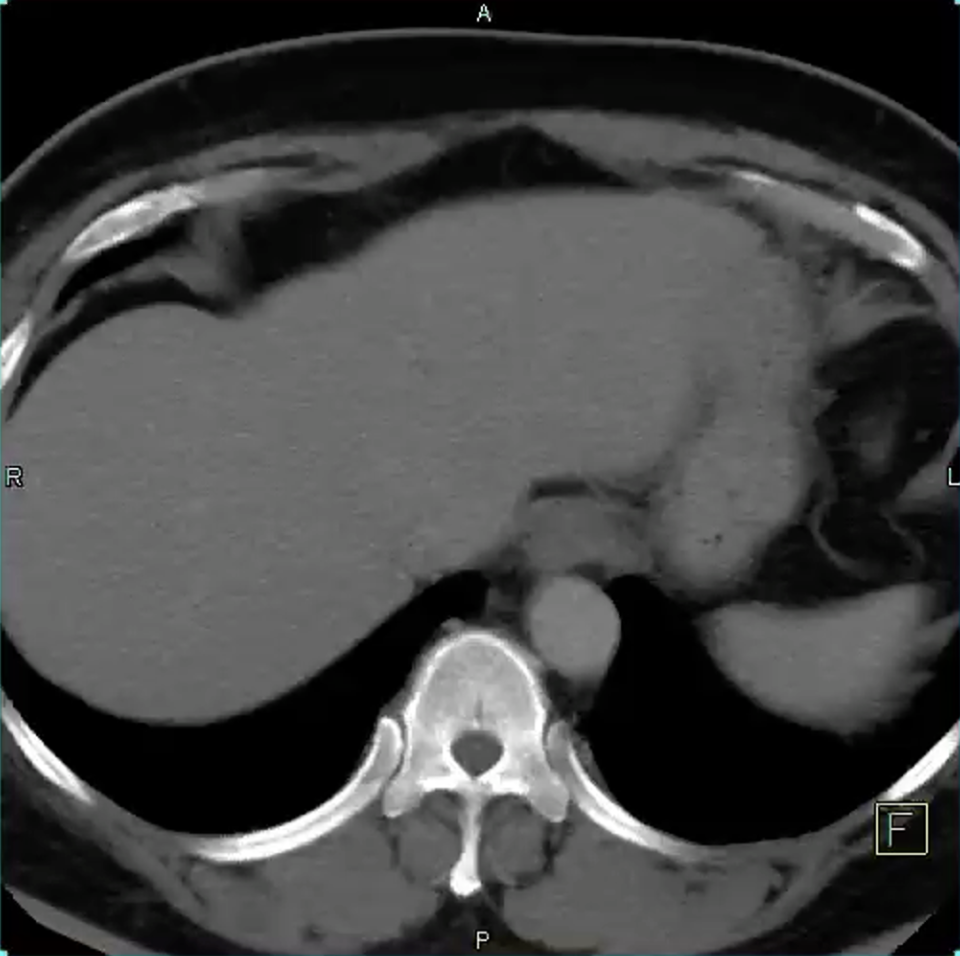 CT of the Adrenal Mass
