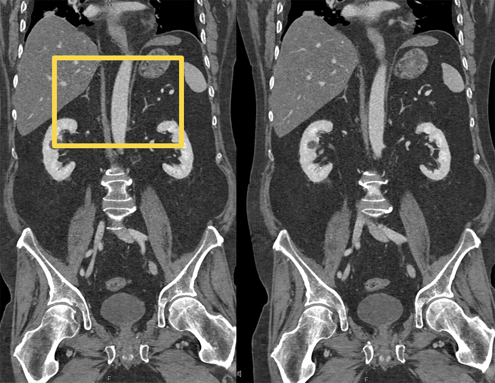 Adrenal Atrophy