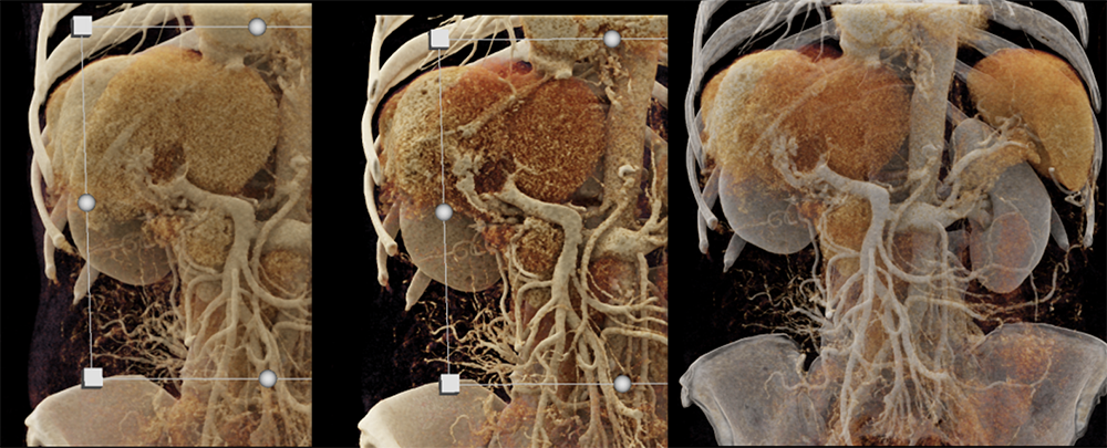 Hepatoma Invades the Portal Vein Using Various CR Presets