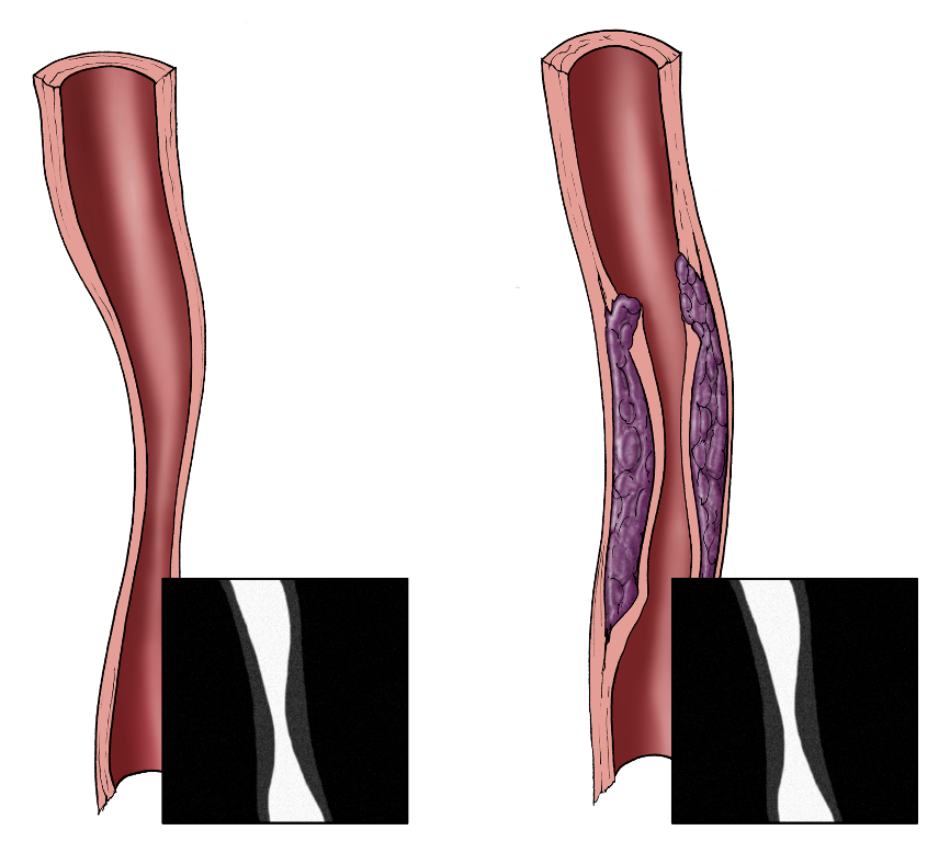 Vascular occlusion and spasm
