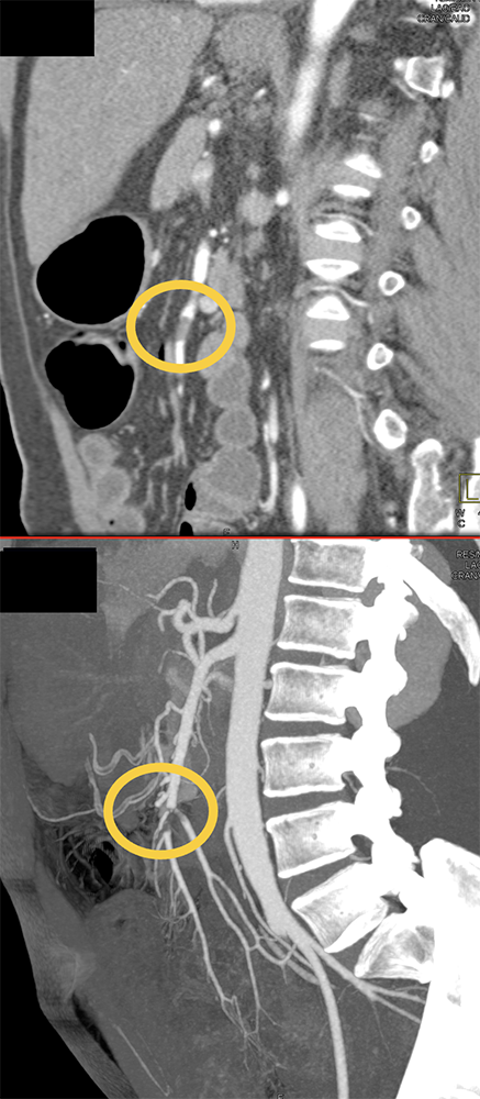 SMA Thrombus