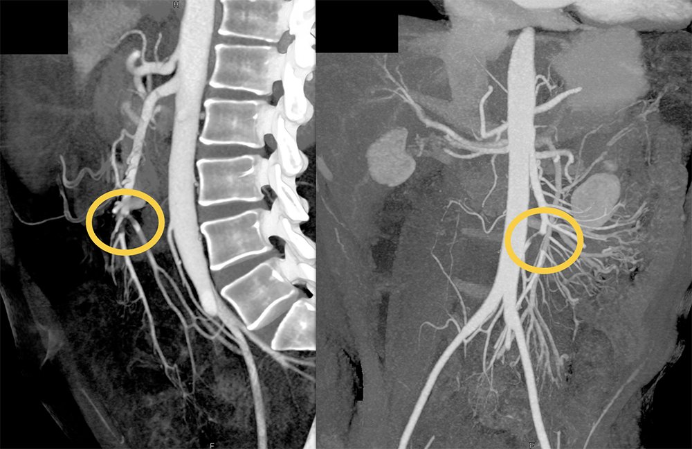 SMA Thrombus