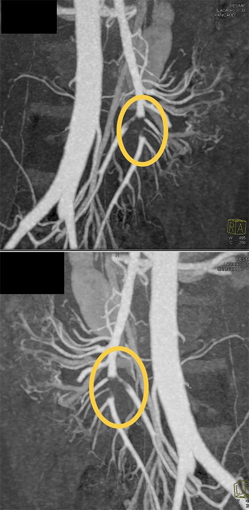 SMA Thrombus