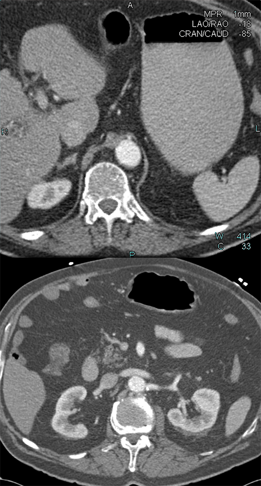 SMA Clot and Ischemic Bowel