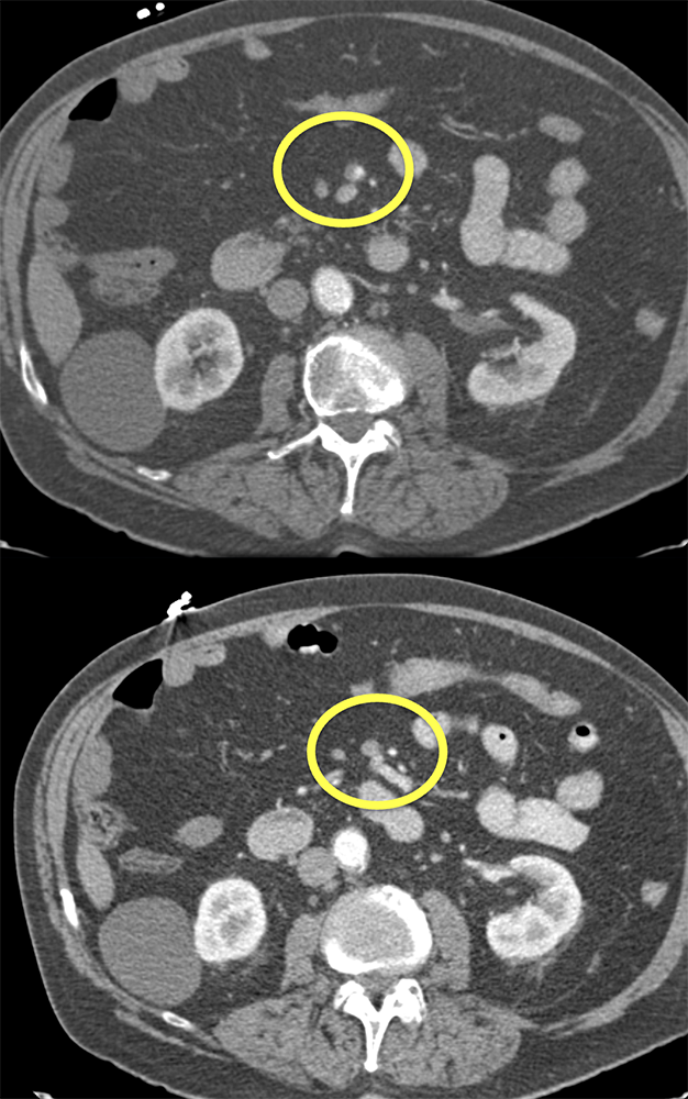 SMA Clot and Ischemic Bowel