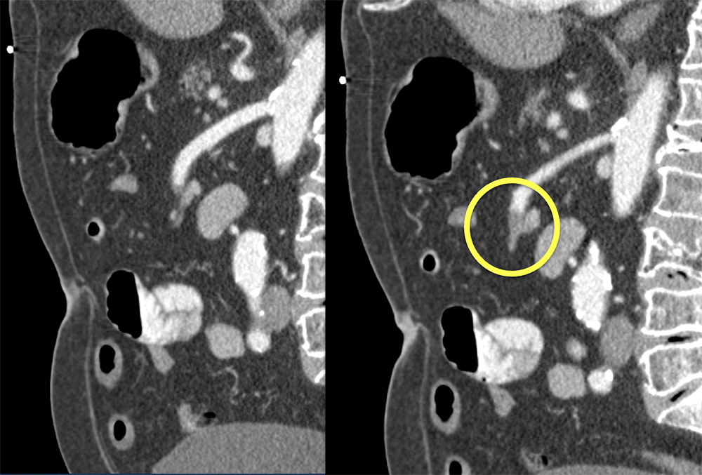 SMA Clot and Ischemic Bowel