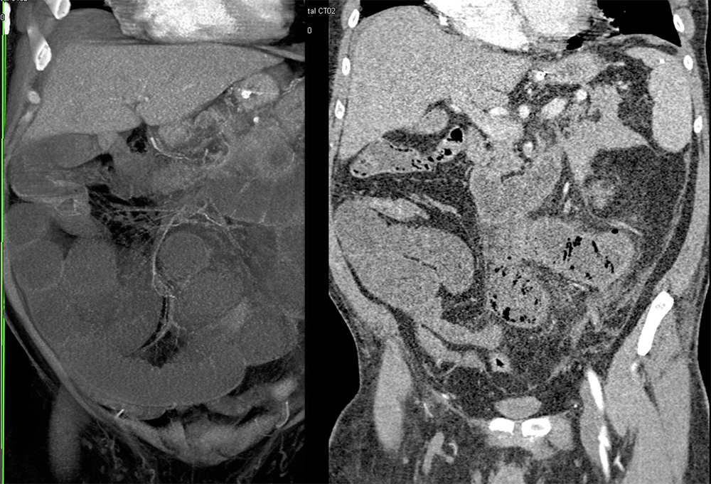 CT of the Aorta and Its Branches