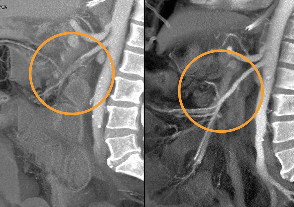 CT of the Aorta and Its Branches