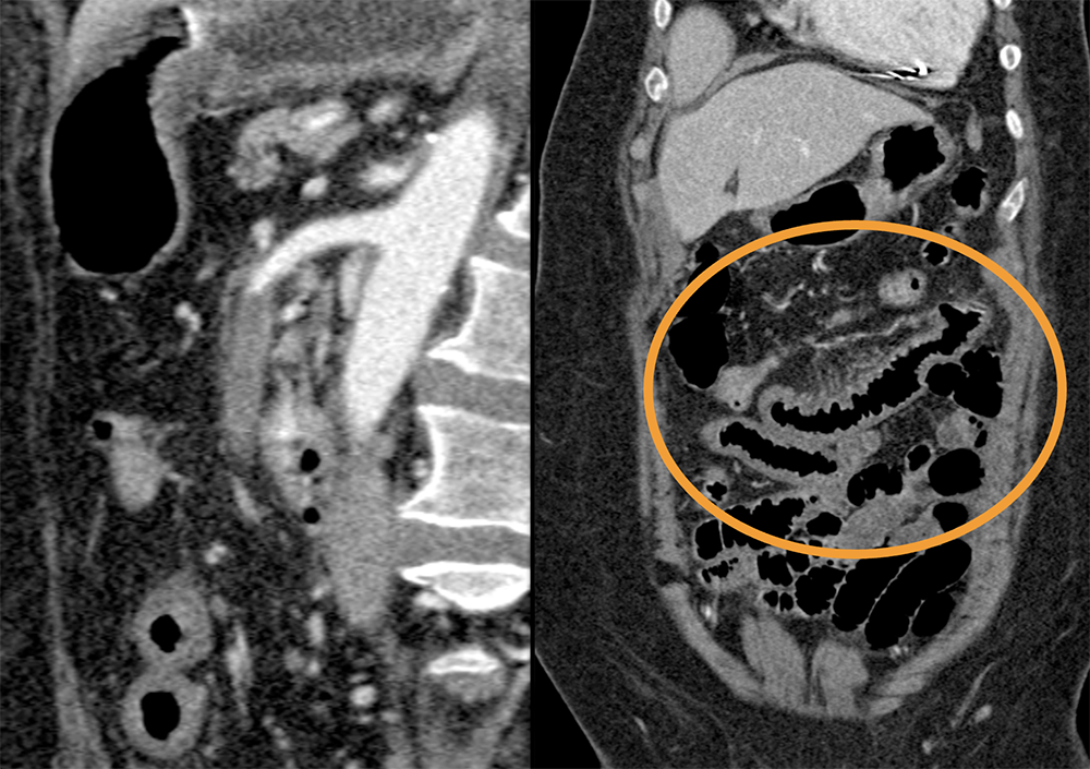 CT of the Aorta and Its Branches