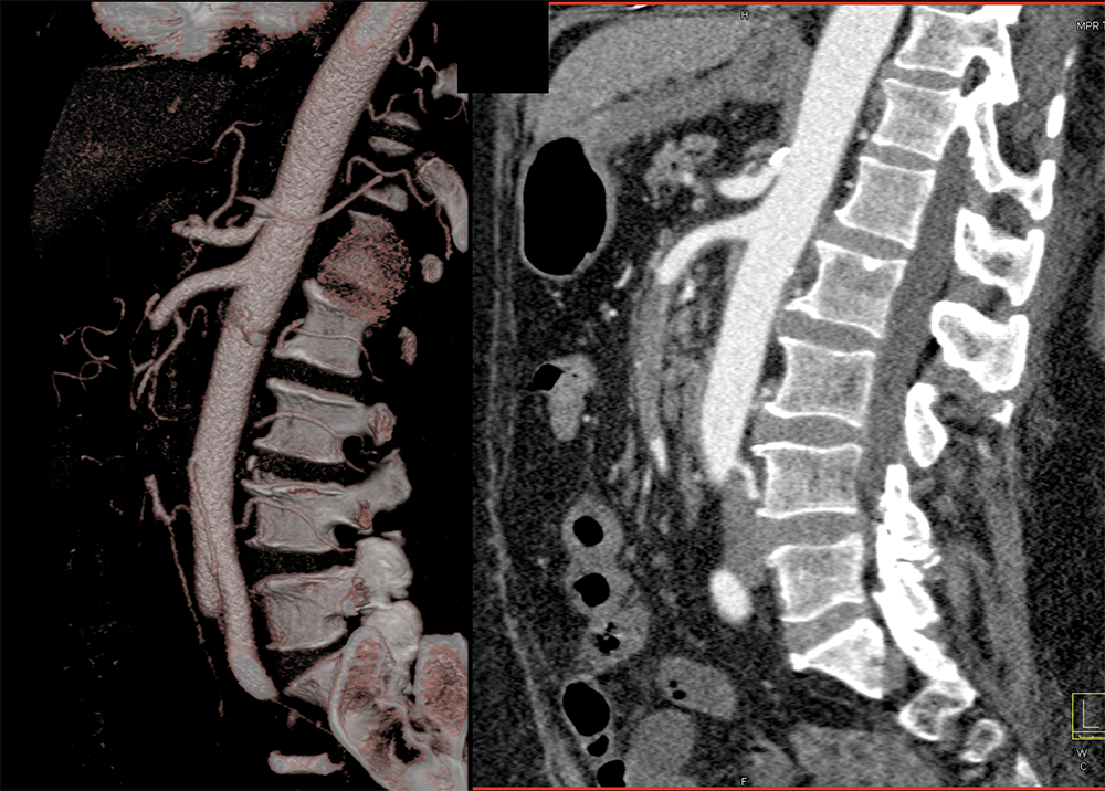 CT of the Aorta and Its Branches