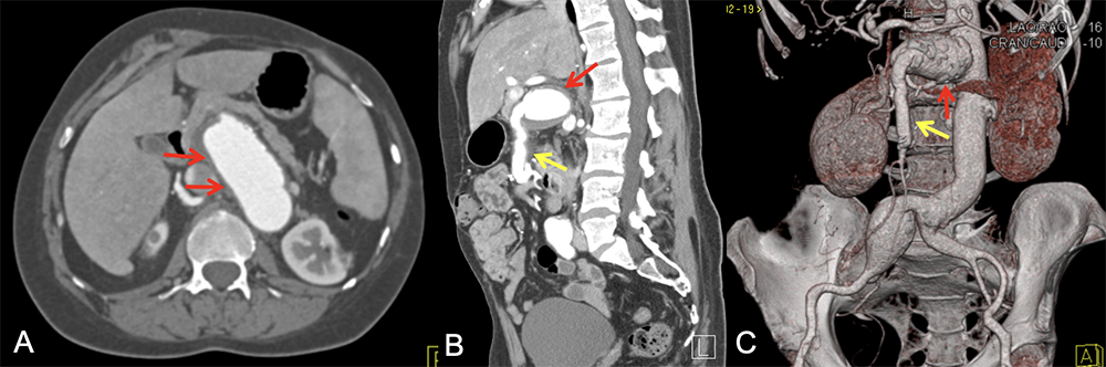 SMA Aneurysm