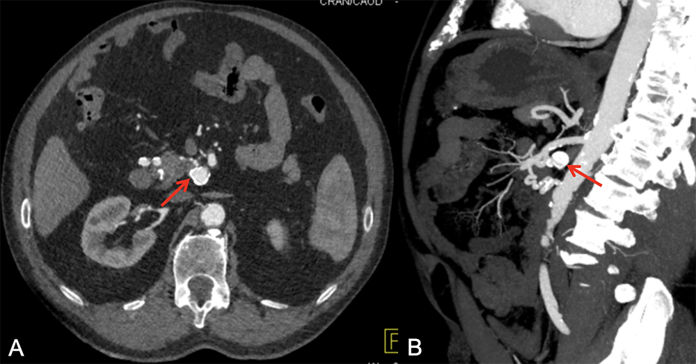 SMA Aneurysm