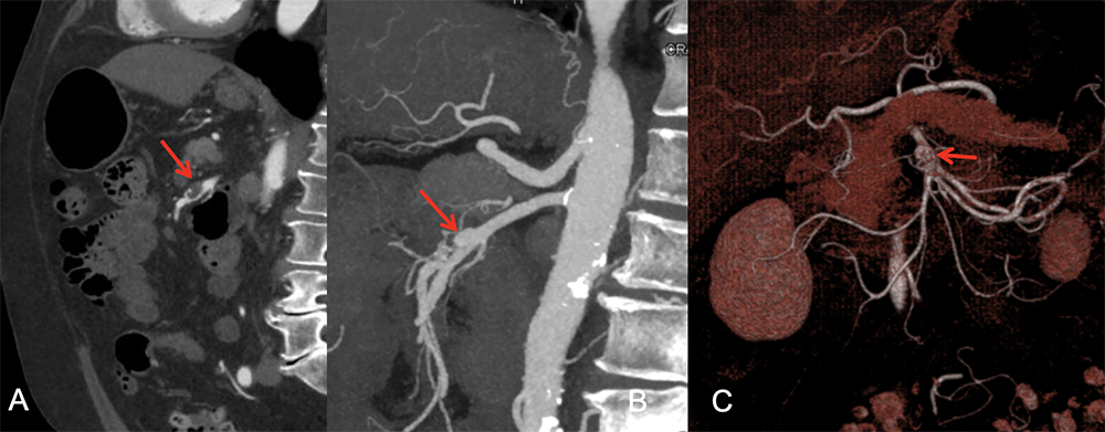 SMA Aneurysm