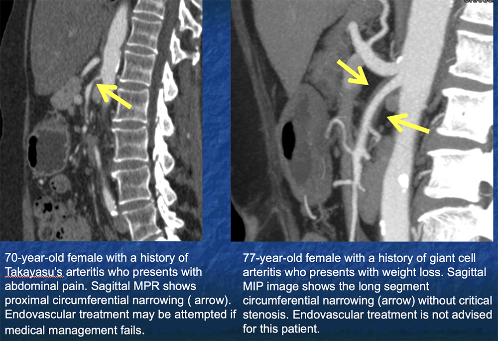 SMA Vasculitis