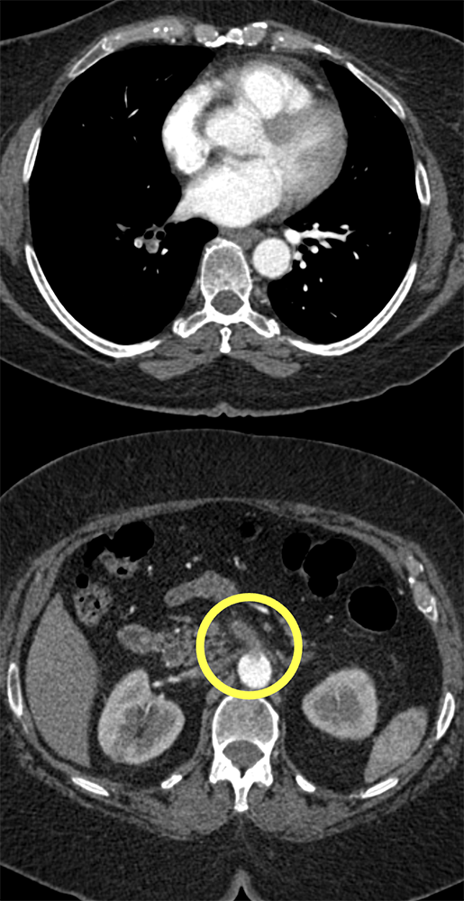 PE and SMA Clot and Renal Infarcts