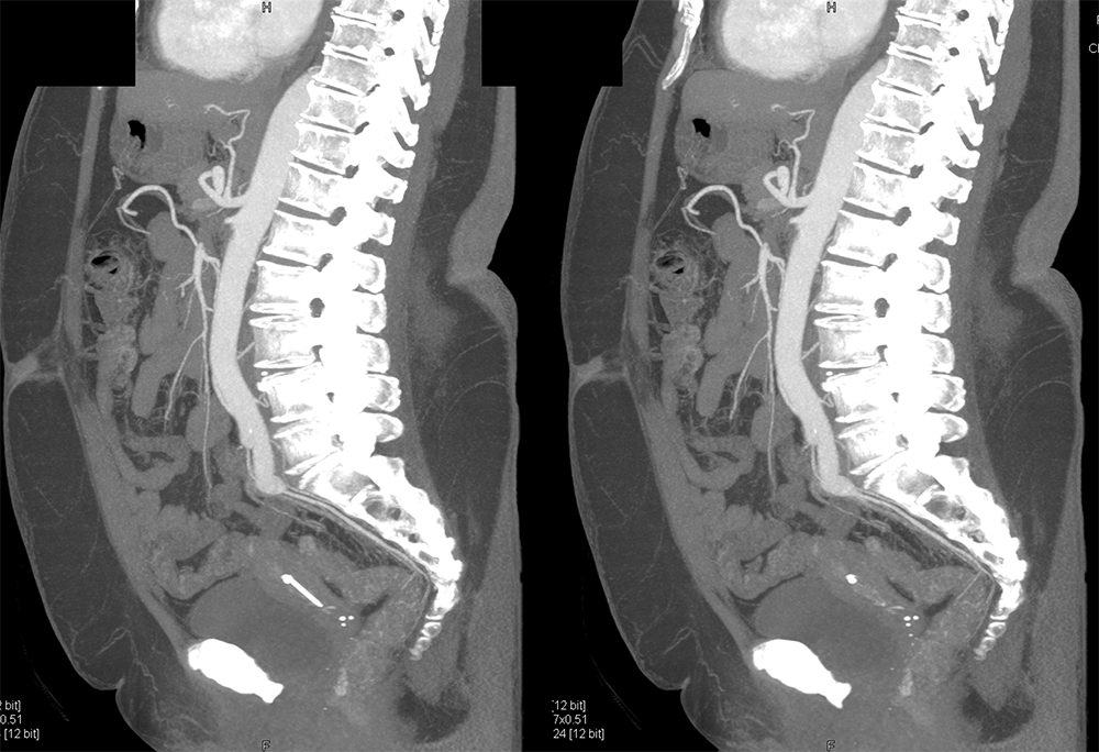 PE and SMA Clot and Renal Infarcts