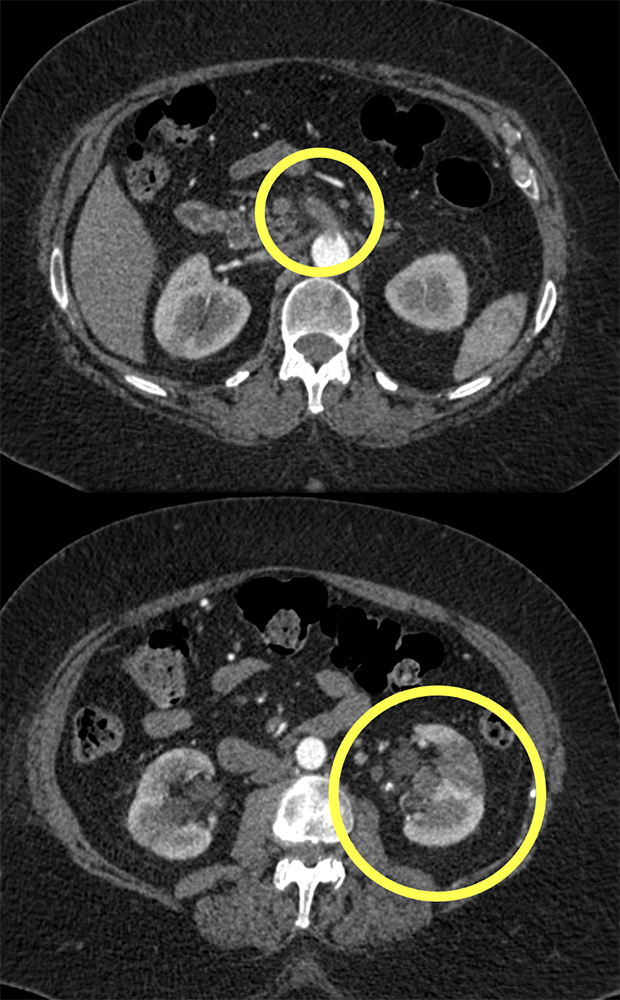 PE and SMA Clot and Renal Infarcts