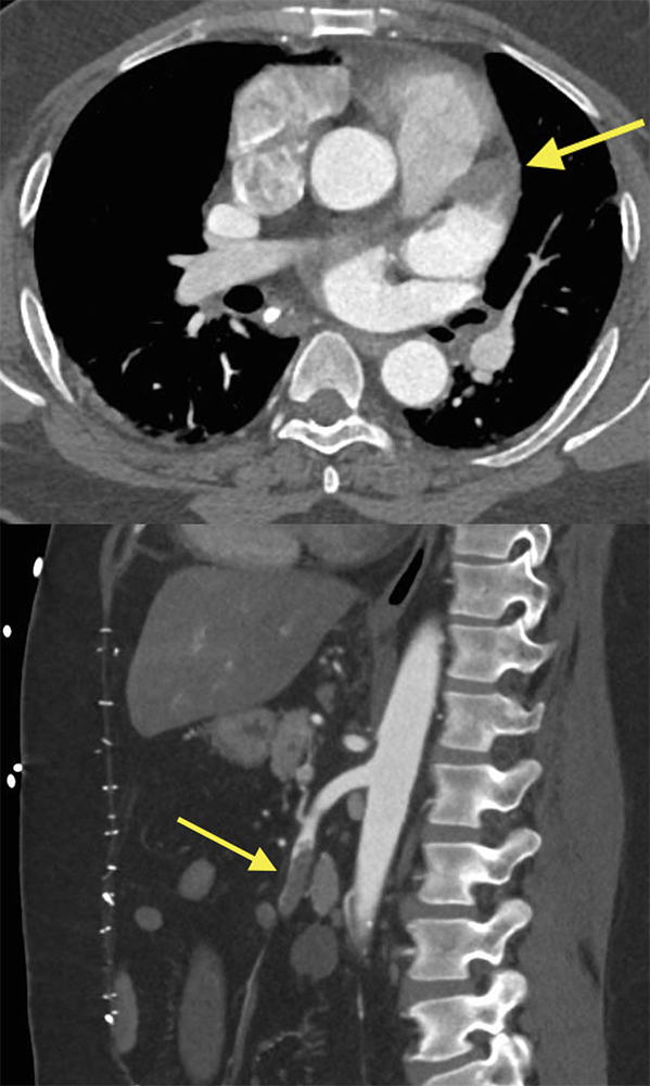 CT of the Aorta and Its Branches