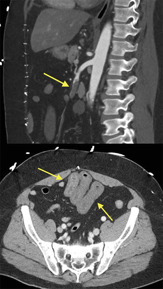 SMA Thrombus: SB Ischemia