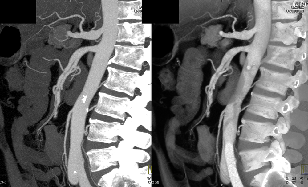 Vague Abdominal Pain