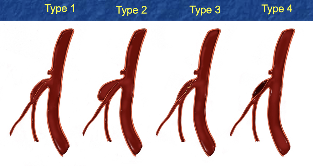 SMA Dissection