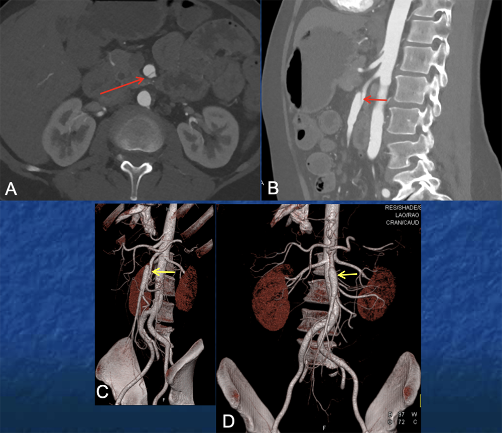 SMA Dissection