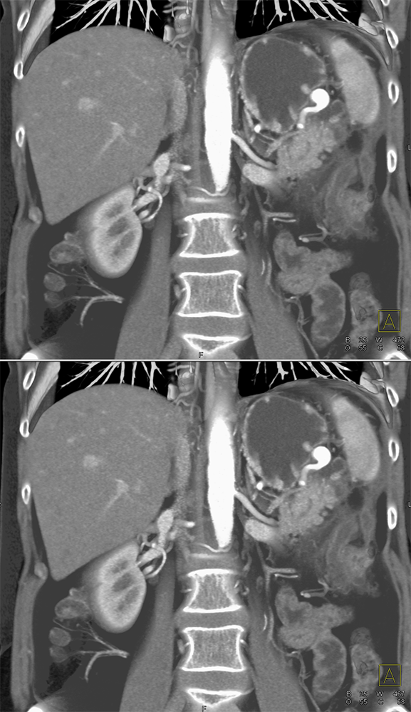 1cm Splenic Artery Aneurysm