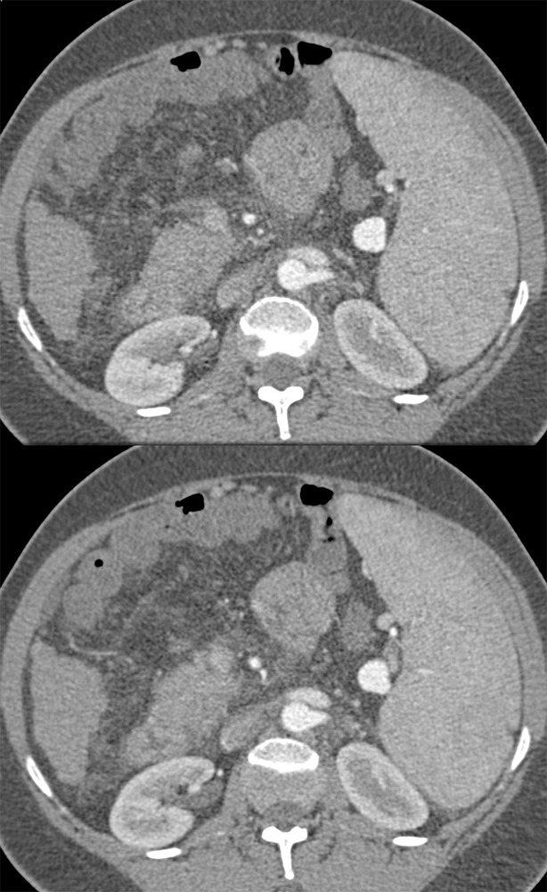 Portal Hypertension and Splenic Artery Aneurysm