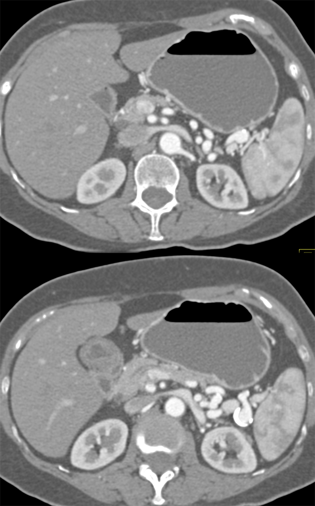 Splenic Artery Aneurysm