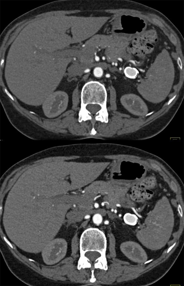 Splenic Artery Aneurysm