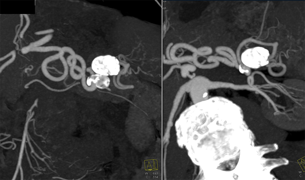 Splenic Artery Aneurysm