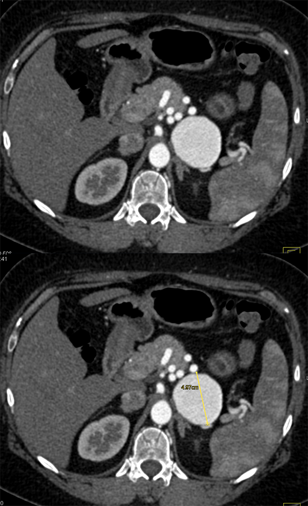 Giant Splenic Artery Aneurysm