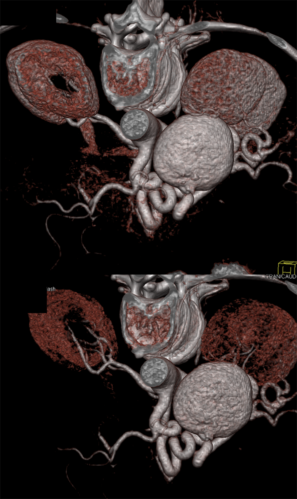 Giant Splenic Artery Aneurysm