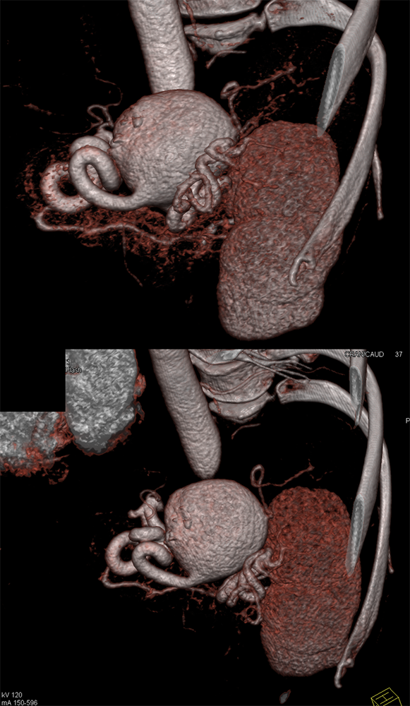 Giant Splenic Artery Aneurysm