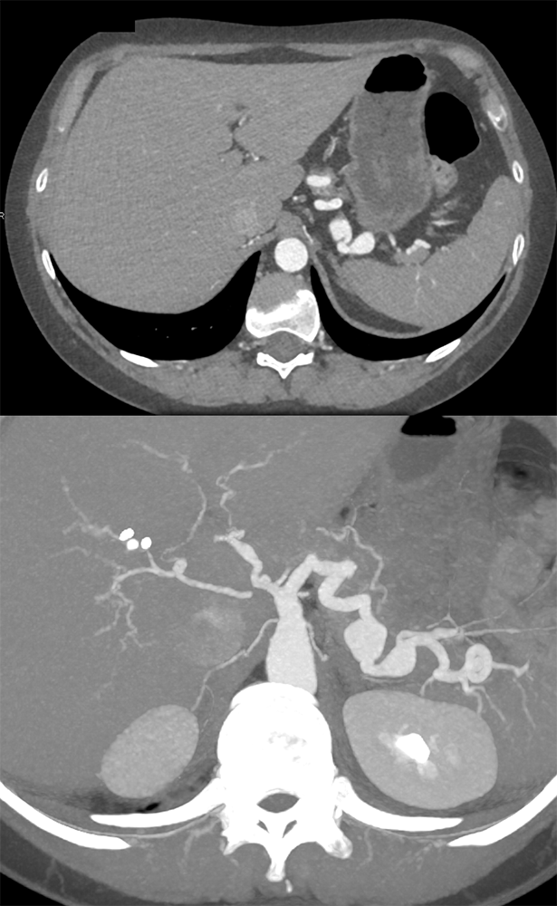 Celiac and Splenic Artery Aneurysms and Ehlers Danlos Syndrome