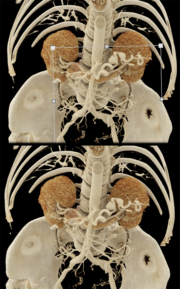 Celiac and Splenic Artery Aneurysms and Ehlers Danlos Syndrome