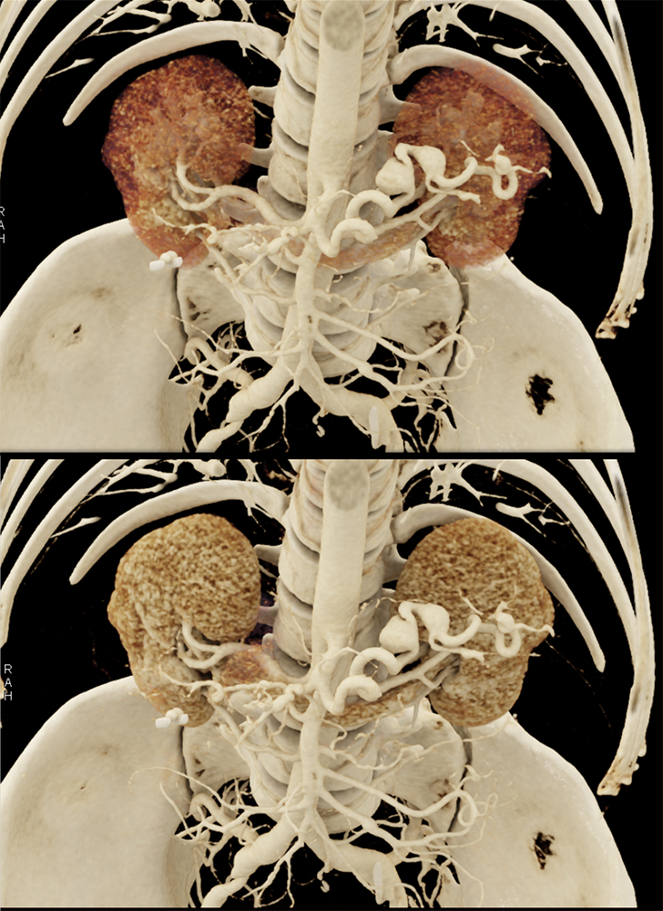 Celiac and Splenic Artery Aneurysms and Ehlers Danlos Syndrome