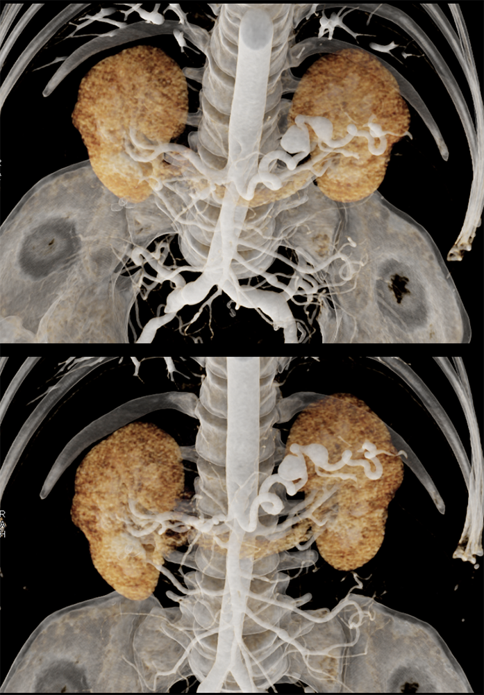 Celiac and Splenic Artery Aneurysms and Ehlers Danlos Syndrome