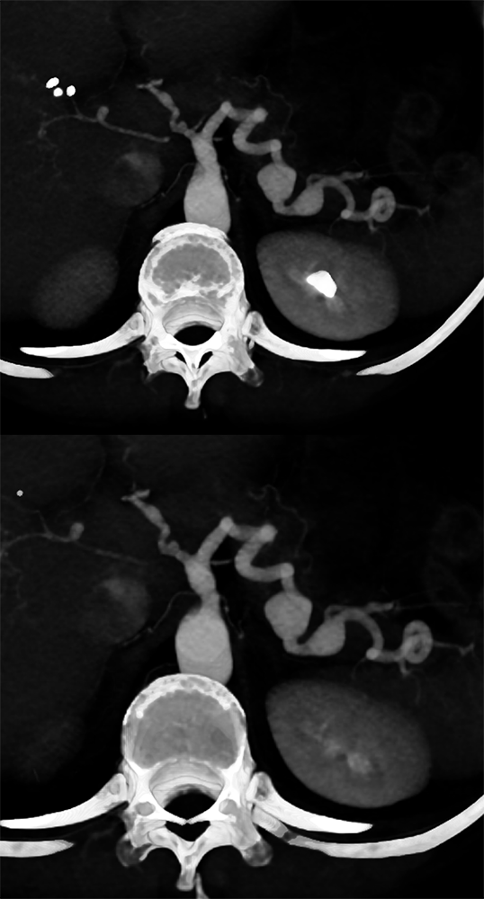 Celiac and Splenic Artery Aneurysms and Ehlers Danlos Syndrome