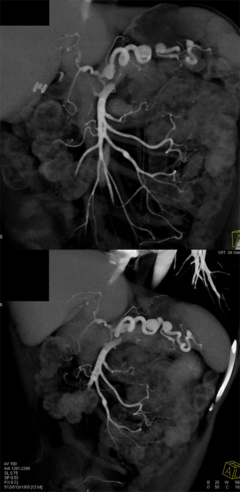 Celiac and Splenic Artery Aneurysms and Ehlers Danlos Syndrome