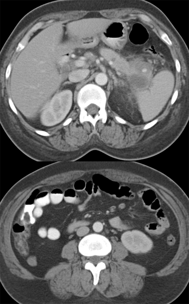 Spenic Artery Pseudoaneurysm