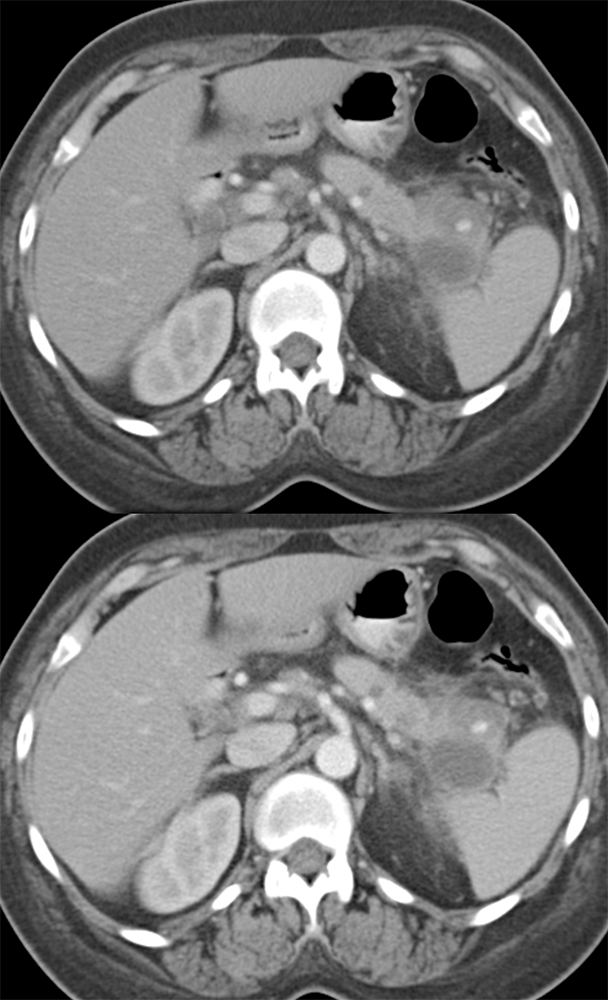 Spenic Artery Pseudoaneurysm