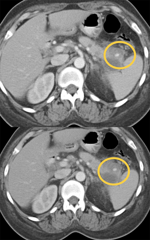 Spenic Artery Pseudoaneurysm