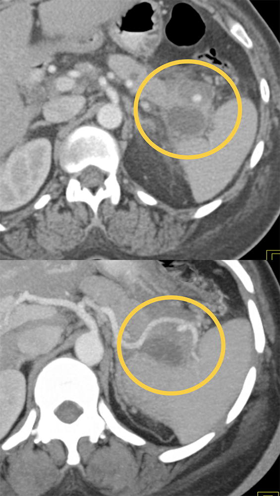 Spenic Artery Pseudoaneurysm