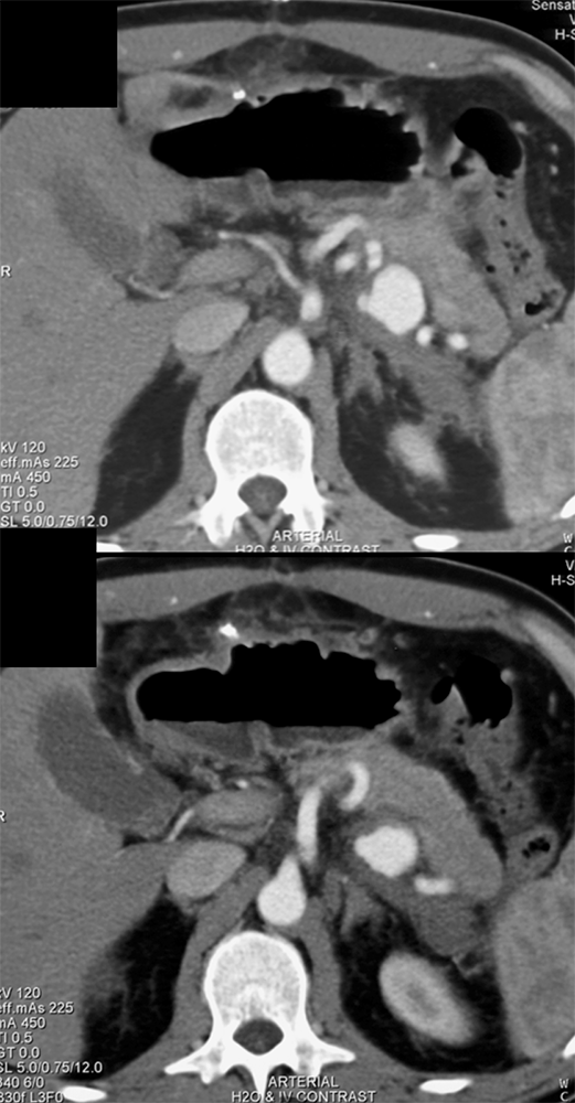 Splenic Artery Pseudoaneurysm