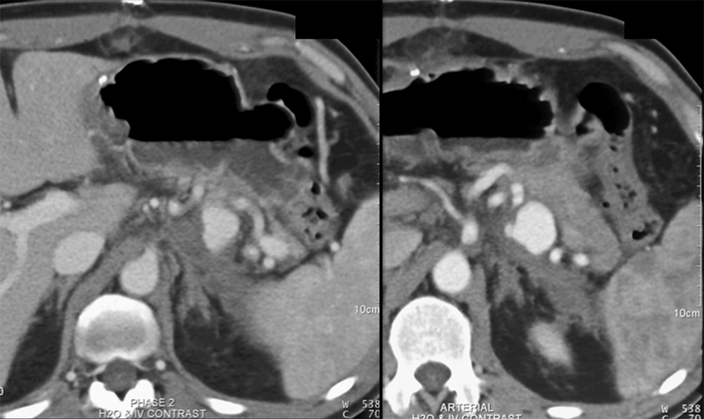 Splenic Artery Pseudoaneurysm