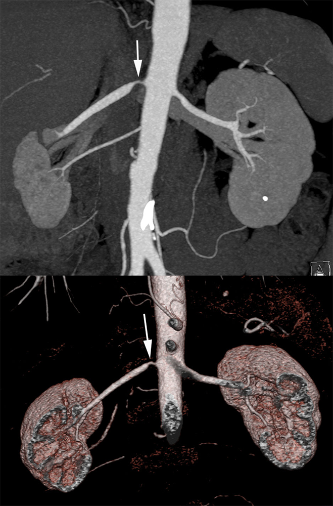 Renal Artery Stenosis